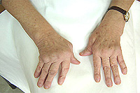 treatment of rheumatoid arthritis