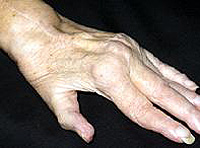 Rheumatoide Arthritis