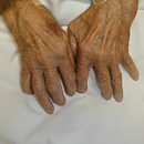 treatment of rheumatoid arthritis-2