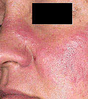 What is a systemic red lupus?