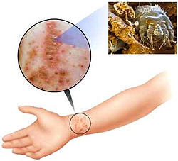you need to know about scabies