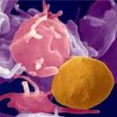 megakaryocytes and platelets value with thrombocytosis