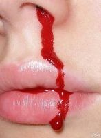 Prevention of bleeding with hemophilia