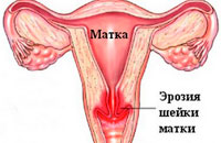 Érosion cervicale