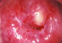 cervical cyst