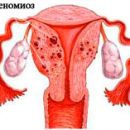 uterine adenomyosis
