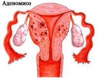 uterine adenomyosis