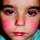 Kawasaki syndrome is the cause of sudden death in children