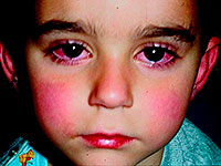 Cavasaki syndrome & ndash; Cause of the sudden death of children!