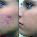 salicylic acid acne and not only