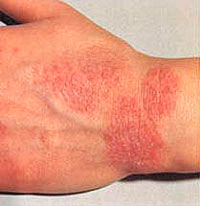 Eczema on her arms