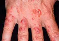 dermatitis on hands