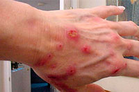 Dermatite em seus braços