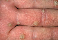 Warts on hands