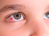causes eye redness and treatment