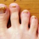 nail fungus on your feet all about the disease
