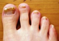 Nail gombusz a lábakon: a betegségről