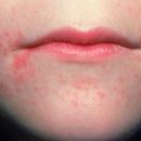 rash around the mouth or oral dermatitis manifestations of food