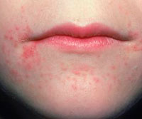 rash around the mouth or oral dermatitis manifestations of food