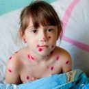 how and what to smear chickenpox means to combat a rash