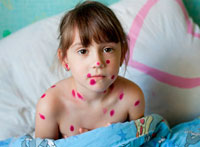 how and what to smear chickenpox means to combat a rash