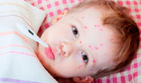how quickly defeat the chickenpox treatment with acceleration