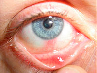 Rötung der Augen: Ursachen und Behandlung