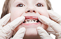 types of superficial and deep caries tooth decay in children