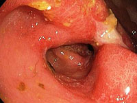 Gastric ulcer aggravation: causes, symptoms and actions
