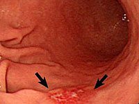 Stomach ulcers in children & mdash; Symptom of uncontrollability