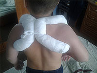 clavicle fracture in children