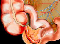 Differentiell diagnos av appendicit hos barn