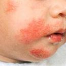intolerance to food allergy symptoms in children