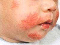 Types of allergies in children
