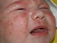 Tecken på allergier hos barn