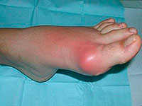 Exacerbation of Gout: Is it so terrible, how is his little?