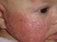 Alergija na hranu kod male djece