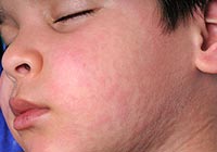 treatment of mumps