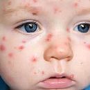 Chickenpox in children causes and symptoms