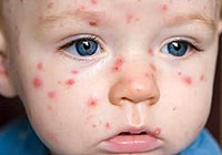 Chickenpox in children causes and symptoms