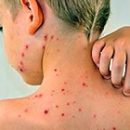 how to treat chickenpox possible to protect the baby from infection