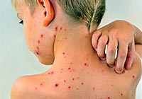 how to treat chickenpox possible to protect the baby from infection