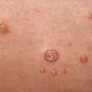 infectious skin diseases in children