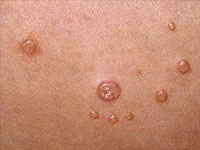 Zarazne bolesti kože u djece