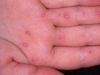 Infekčné kožné ochorenia u detí: Základné zobrazenia