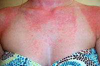 Alergija saulei ar fotodermatitui