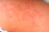 Allergia a napra vagy a fotodermatitisre