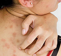 Symptoms of food allergies in adults