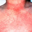 scarlet fever symptoms and the development of