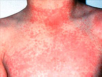 scarlet fever symptoms and the development of